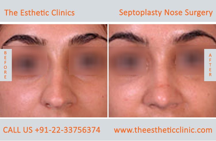Septoplasty Nose Surgery before after photos in mumbai india (3)